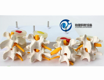 4阶段病态腰椎比较模型